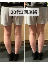 ミーツ(MEETS)/O脚