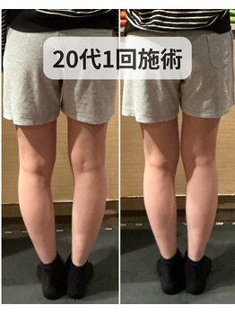 ミーツ(MEETS)/O脚