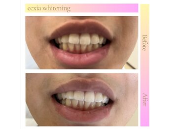 エクシアホワイト 広島袋町店/ホワイトニングビフォーアフター