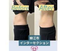 腰の整体インターセクション/ウエスト引き締め