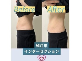 腰の整体インターセクション/ウエスト引き締め