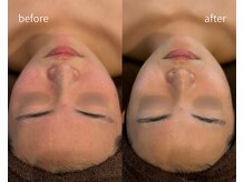 ヒミー(himee)/ハーブピーリング/毛穴/肌質改善