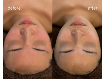 ヒミー(himee)/ハーブピーリング/毛穴/肌質改善