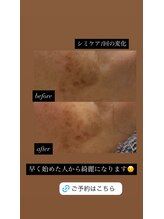 リノ(Lino)/シミケア1回の変化