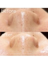 ルルラ リコ(lulula rico)/症例写真/ハイドラ毛穴洗浄