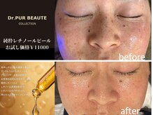 マイルーチェ 可児川合店(MyLuce)の雰囲気(Dr.PUR BEAUTE 純粋レチノールピール 土台から肌質改善!)