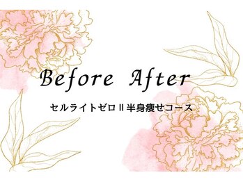 キレイ(KIREI)/セルライトゼロ2半身やせコース