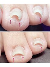 プレシオサ ネイル(Preciosa Nail)/親指以外の巻き爪補正