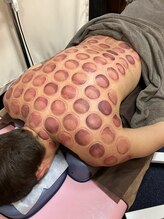 仁接骨院 じん鍼灸治療院/カッピング施術例