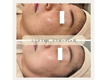 ニコ ウィズ(Nico with)/シミケア