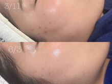 ロイ 初生店(LOI)/プラズマ×韓国リジュラン