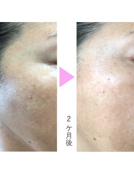 モモン シャルール/しみケアで透明感up