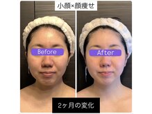 レガロビューティ 麻布十番(REGALO Beauty)の雰囲気（[美肌＋小顔へ]フェイスラインの脂肪を減らし、お肌も整えます）