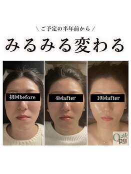キュープ 松戸店(Qpu)/小顔矯正を継続された方の変化