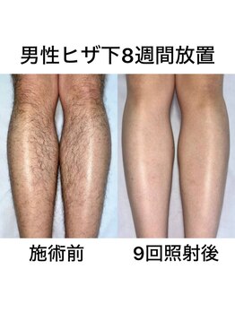 クリアランス(CLEARANCE)/露出部分脱毛