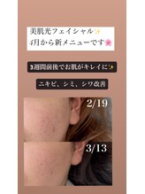 スイ(Sui)/美肌光フェイシャル 光顔脱毛