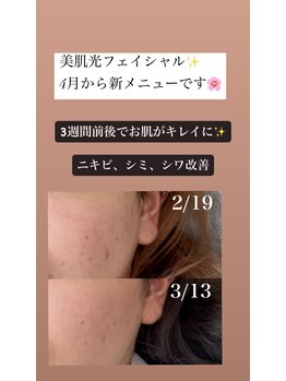 スイ(Sui)/美肌光フェイシャル 光顔脱毛