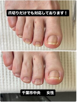 巻き爪じゅん 船橋店/巻き爪以外のお悩みにも対応!