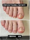 巻き爪以外のお悩みにも対応!