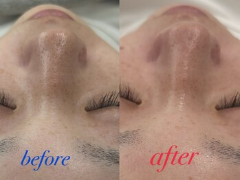 ファーファラ(Farfalla)/水光ピーリング