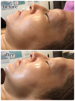 シロエルヴィ(SILOE)の写真/「老け見え」の影にアプローチ。深く刻まれたほうれい線・たるみに、最新成分で細胞から喝◎