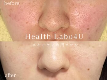 ヘルスラボフォーユー(Health Labo4U)の写真/卒業できる【ニキビ改善専門店】お客様一人ひとりに寄り添い、肌トラブルを徹底ケア！