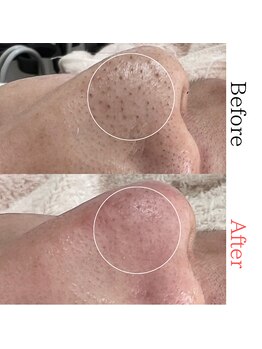 ボータン 恵(Beau Temps)/毛穴ケア/毛穴洗浄　【施術例】