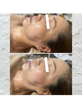 エソール(essor)/フェイシャルハーブピーリング♪