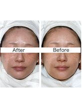 ビューティースペース 松戸店/光フェイシャルお試し