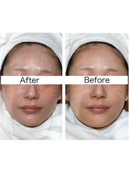 ビューティースペース 松戸店/光フェイシャルお試し