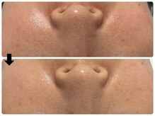 エフェクト 塚口店(effect)/Before After &nbsp;&nbsp;30代/4回目