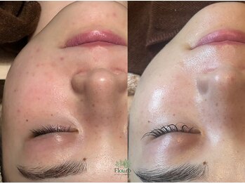 フラーブ(Flourb)/ハーブピーリング|症例写真