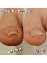 ニコルル 大阪天満店(Nicolulu)/長時間歩くと痛くなる巻き爪