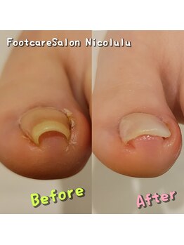 ニコルル 大阪天満店(Nicolulu)/長時間歩くと痛くなる巻き爪