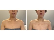 九月屋/二重あごが気になる方は