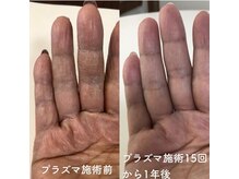 ビーダブリュー(BW...)/☆プラズマゼノデュアル施術例☆