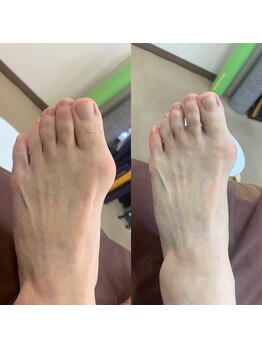 ニコ(niko)/足指の外反ケア初回の変化です