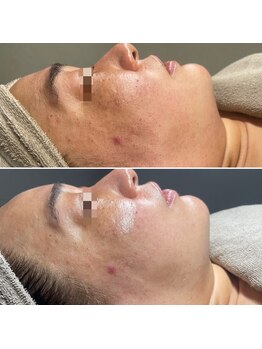 コルギ デ コガオ(KORUGI de KOGAO)/UDM超小顔リフティング肌管理