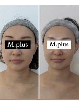 エムプリュ 心斎橋店(M.plus)/小顔施術7回！