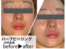 サロンスペース/20代女性【ハーブピーリング】