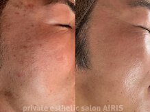 一人一人に合わせたオーダーメイド施術で最短でお肌の改善◎