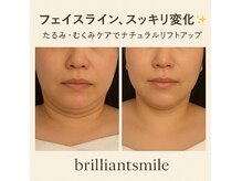 レモンボトルで二重顎・フェイスラインをスッキリ小顔へ