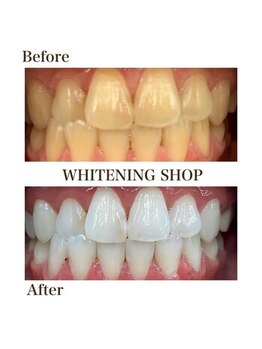 ホワイトニングショップ 下関店/タバコ汚れ/13～15回照射