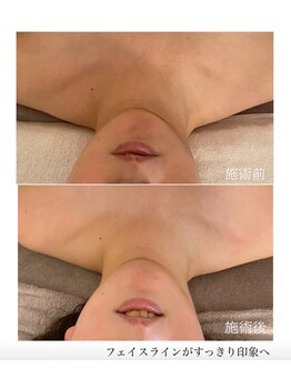 ピーロ ルレ(salon Piilo Rule)の写真/【ほうれい線、たるみ改善!予防ケア】「最近なんか違う」 そのままにしていませんか?