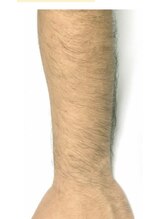 しん整骨院/メンズ両肘下脱毛