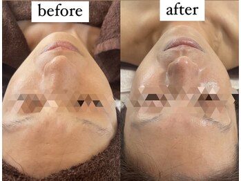 サロンルカ(SALON RUKA)/ハーブピーリング