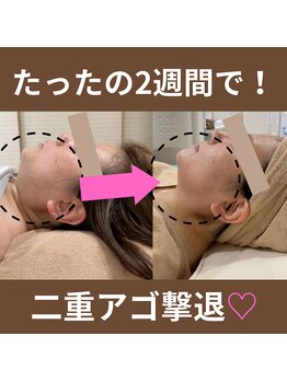 カブール 町田/たったの2週間で二重アゴ撃退!