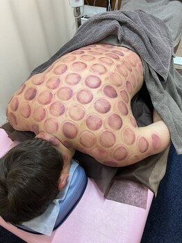 仁接骨院 じん鍼灸治療院/カッピング施術例