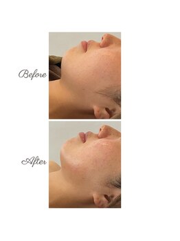 ウルエッテ(UluEtte)/フェイスラインのもたつき/福岡