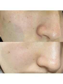 ナーススキン(nurse skin)/ビフォーアフター5